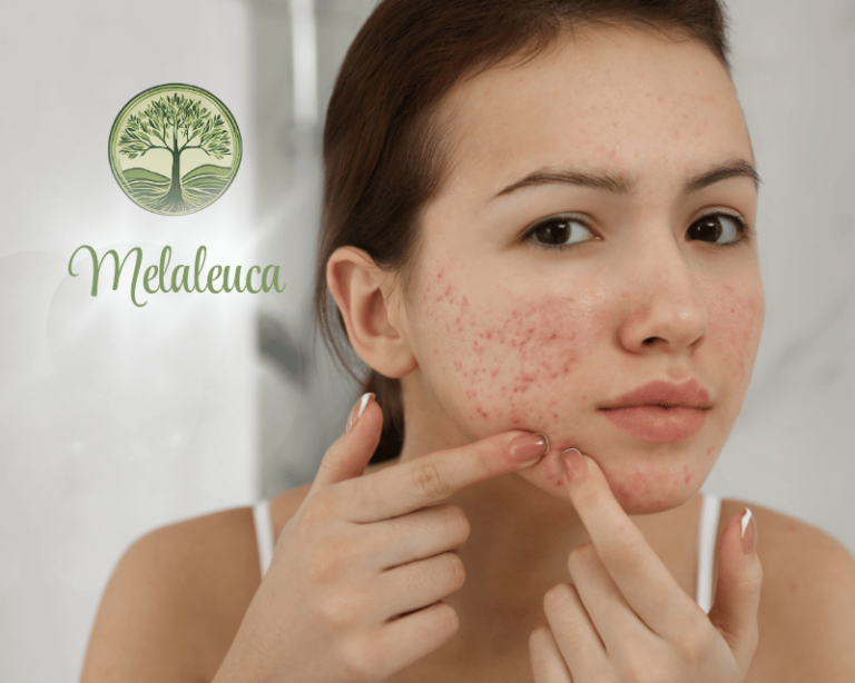 Melaleuca é utilizada para tratamento de Acne