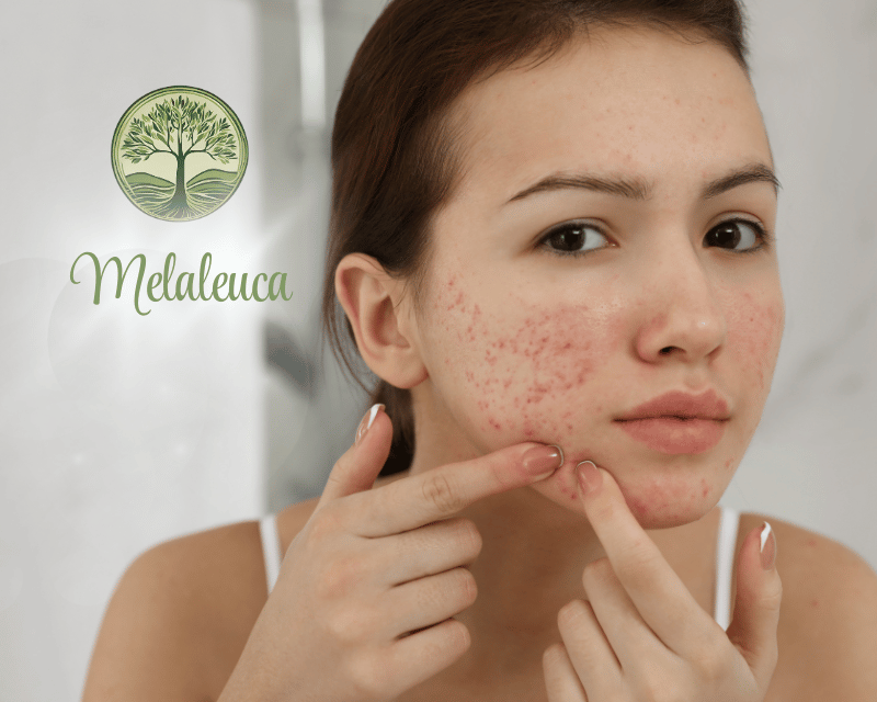 Melaleuca é utilizada para tratamento de Acne